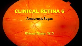 Clinical Retina 6  Amaurosis Fugax [upl. by Hartill811]