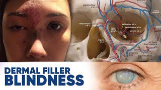 Understanding Dermal Filler Blindness Causes Risks amp Prevention [upl. by Notgnimer569]