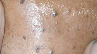 sac dep spa blackheads elderly 2023  sac dep spa blackheads new  skin cyst treatments 2023 [upl. by Ahseia829]