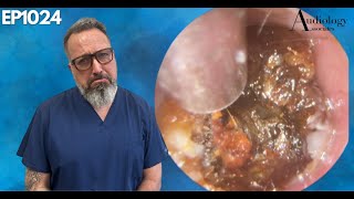 Irritated Ear Canal Wax Removal  EP1024 [upl. by Thedrick315]