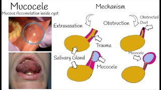 Oral Mucocele  The Most Common Mucosal lesion  Mucous Cyst Symptoms Causes amp Treatment [upl. by Atiugal]