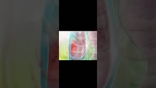 pneumothoraxpathologyhealth doctor medicine viral shorts usa us disease pneumothorax [upl. by Maffa]