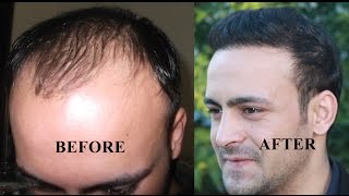 Hair transplant before and after Hair Restoration Turkey  Istanbul [upl. by Peti]