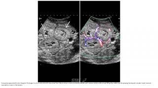 Mesenchymal Hamartoma Imaging [upl. by Craner]