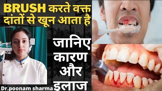 Brush करते वक्त दांतों से खून आता है तो जानिए कारण और इलाज brushing karne per dant se khoon aana [upl. by Jessy564]