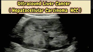 Liver Cancer  Hepatocellular Carcinoma HCC  Hepatoma Ultrasound [upl. by Sseb]