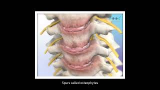 Osteophytes formation Siffness in Bone articulation [upl. by Arjun910]