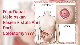 FiLAC Penyelamat Colostomy  Yuk Cari Jawabannya Di sini [upl. by Eceela]