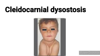 Cleidocranial dysostosis  Cleidocranial dysplasia  Basic concept building [upl. by Yemar]