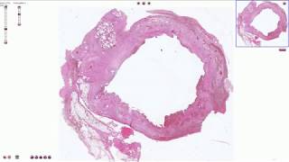 Chronic Cholecystitis  Histopathology [upl. by Merkley]