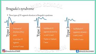 Brugadas syndrome [upl. by Gardy]