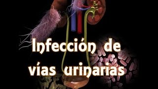 Infección de vías urinarias IVU [upl. by Ahsenat]