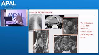 Cancer Bronchique  lapport du Pneumologue Liberal  Pr DIHADADEN  APAL ORAN MAI 2024 [upl. by Levina]