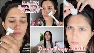 Derma stamp benefits for hair fall amp aging  Hairfall guide by Natasha waqas [upl. by Saint]