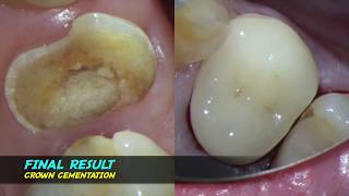 single visit root canal therapy endodontic one curve micromega warm vertical compaction [upl. by Calla]