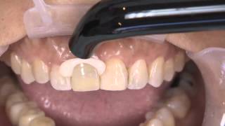 How to Complete an Anterior Dental Restoration with Kerrs Nexus RMGI [upl. by Ebbarta681]