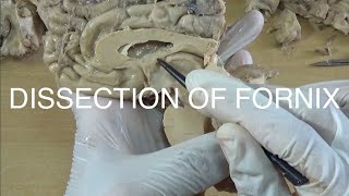 DISSECTION OF FORNIX [upl. by Socem]