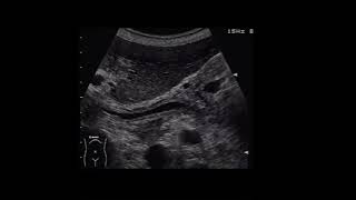 Cholangitis shorts ultrasound radiopedia videoshortsctmrixraybasicsradiantbestyoutube [upl. by Veronica]