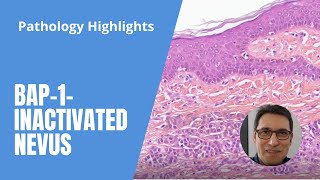 Pathology Highlights  BAP1inactivated nevus typical case with link to virtual slide [upl. by Yrallih]