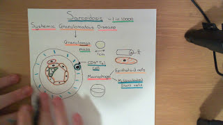 Sarcoidosis Part 1 [upl. by Pylle]