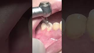 Tooth rebuild with fiber post and composite restoration dentist [upl. by Adnilg]