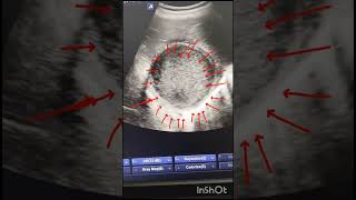 pyogenic hepatic abscess liver ultrasound medical sonologist radiology pocus [upl. by Im814]