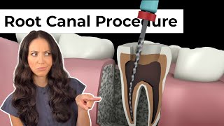 Root Canal Procedure Step by Step [upl. by Enaitsirhc]