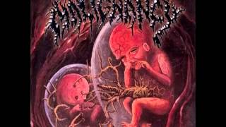 Malignancy  Intrauterine Cannibalism 1999 Full Album United Guttural Records [upl. by Imoyn]