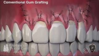 Correcting Receding Gums through Pinhole Surgery [upl. by Ainig]