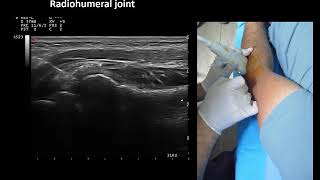 Ultrasound guided elbow radiohumeral joint injection by Prof Murat Karkucak MD [upl. by Justine]