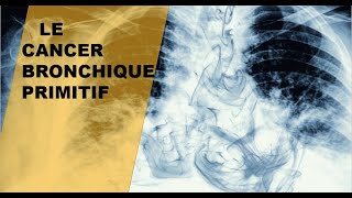 RESUME  Le cancer Bronchique Primitif  symptômes Causes  diagnostic et traitement  1PNEUMO [upl. by Renado]