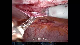 HD4K ROBOTIC Ventral  umbilical hernia repair [upl. by Irby401]