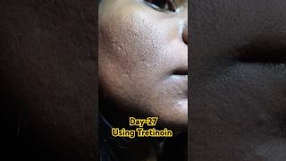 Day27 Using Tretinoin 0025 cream viralvideo tretinoin tretinoincream shorts youtubeshorts [upl. by Jez]