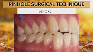 Dr Nemeths Success in Reversing Gum Recession 🦷 🔄 [upl. by Anomor]