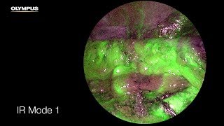 RealTime Fluorescence Infrared Laparoscopy  How it works [upl. by Acsicnarf]