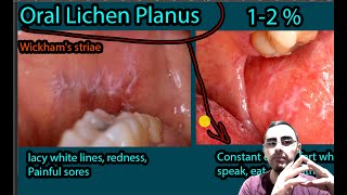 Oral Lichen Planus  Symptoms Causes Treatment Wickhams striae [upl. by Weisman]