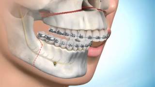 Chirurgie Maxillofaciale et orthodontie [upl. by Risteau]