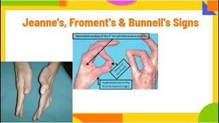 jeannes froments amp Bunnells signs  ulnar neuropathy PhysiotherapyKnowledge [upl. by Firooc134]