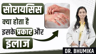 Psoriasis Symptoms Causes and Treatment  Psoriasis Treatment  Dr Bhumika [upl. by Dry158]