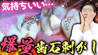 歯茎の中からこんにちは👋🦷大量の隠れ歯石を一網打尽🔥 [upl. by Malim851]