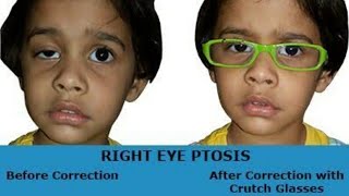 ocular myasthenia gravis treatment in hindi [upl. by Alrak857]