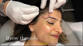 PDOTHREAD LIFT PROCEDURE BY MEDiTHREAD  Eyebrow Lift [upl. by Arahsit501]