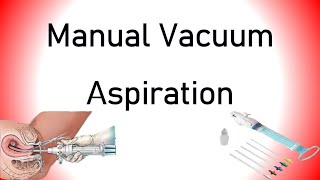 Manual Vacuum Aspiration MVA [upl. by Hindorff744]