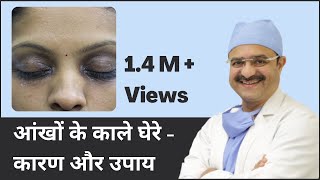 आंखों के काले घेरे  कारण और उपाय Under Eye Dark Circles Causes amp Treatments  In HINDI [upl. by Arema]