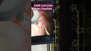 Adult Live Liver Fluke Fasciola found during ERCP [upl. by Bore851]