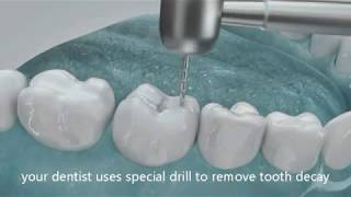 How Dentist fill cavities and holes in tooth [upl. by Mushro264]