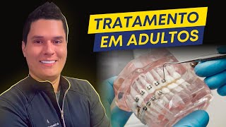 Tratamento Ortodôntico em Paciente Adulto  7 Cuidados Essenciais [upl. by Nroht990]