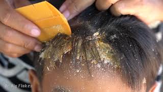 Huge dandruff Flakes  Psoriasis Big Flakes And Picking Itchy Scalp In Side Head 102 [upl. by Steffin104]