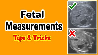 Fetal Measurements Tips and Tricks [upl. by Ymled101]