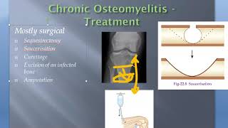 Orthopedics Pyogenic Osteomyelitis Treat Acute Chronic Saucerization [upl. by Tarrel247]